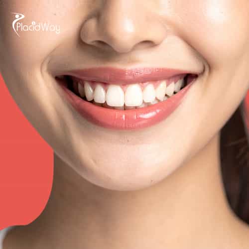 Dental Bridges in San Jose, Costa Rica by Top Dentists